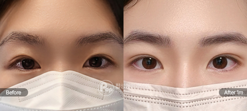 팝성형외과 12홀 자연유착 윗트임 눈재수술 수술 전후 1개월차 눈매 비교 이미지