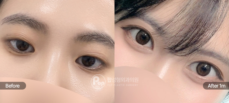 팝성형외과 12홀 자연유착 윗트임 앞트임 수술 전후 1개월차 눈매 비교 이미지