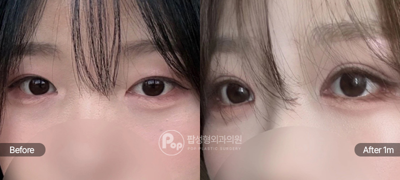 팝성형외과 12홀 자연유착 눈매교정 윗트임 뒤트임 눈재수술 수술 전후 1개월차 눈매 비교 이미지