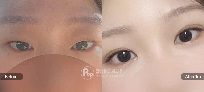 팝성형외과 12홀 자연유착 눈매교정 윗트임 앞트임 눈위지방제거 수술 전후 1개월차 눈매 비교 이미지