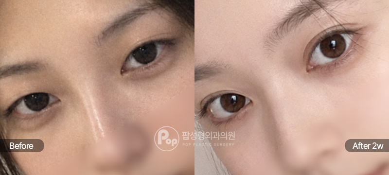 팝성형외과 12홀 자연유착 윗트임 세미아웃라인 수술 전후 2주차 눈매 비교 이미지