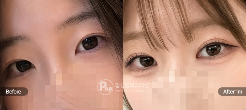 팝성형외과 12홀 자연유착 눈재수술 수술 전후 1개월차 눈매 비교 이미지