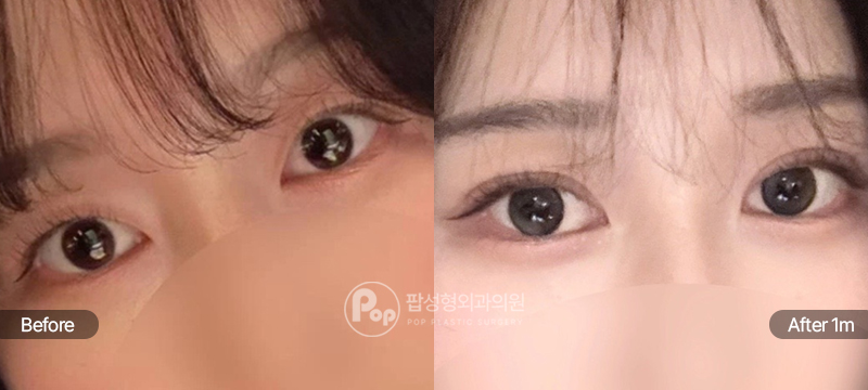 팝성형외과 12홀 자연유착 눈매교정 윗트임 수술 전후 1개월차 눈매 비교 이미지