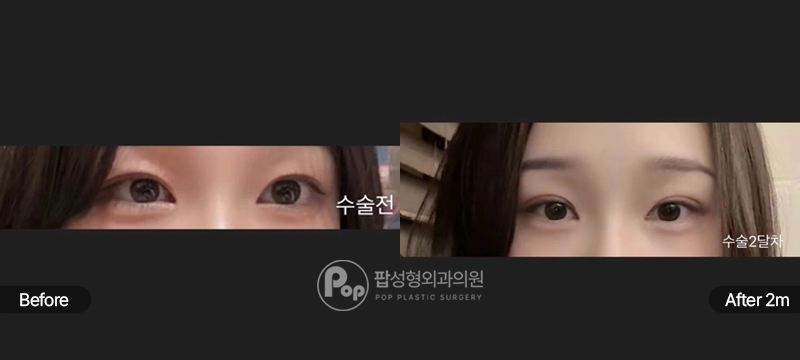 팝성형외과 절개 쌍꺼풀 눈매교정 눈재수술 수술 전후 2개월차 눈매 비교 이미지