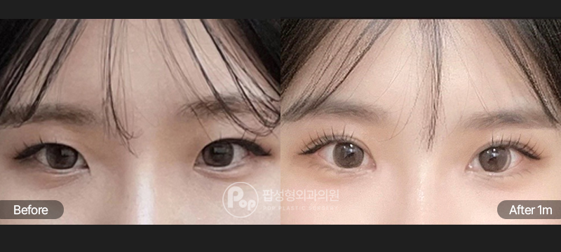 팝성형외과 12홀 자연유착 눈매교정 앞트임 수술 전후 1개월차 눈매 비교 이미지