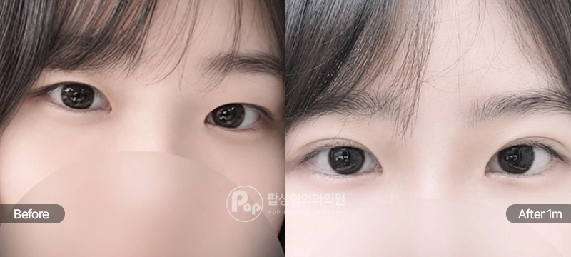 팝성형외과 12홀 자연유착 눈매교정 수술 전후 1개월차 눈매 비교 이미지