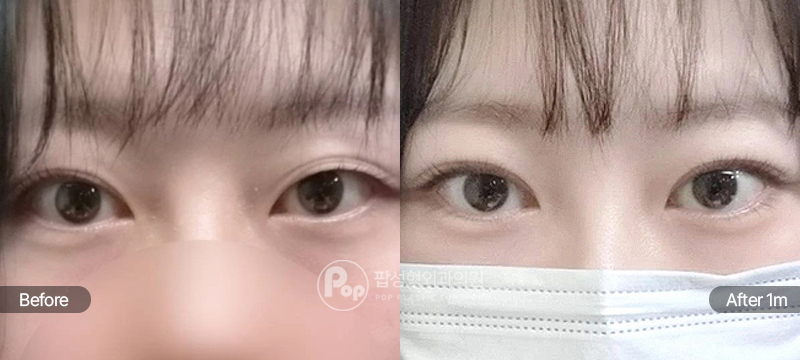팝성형외과 12홀 자연유착 눈매교정 윗트임 눈재수술 수술 전후 1개월차 비교 이미지