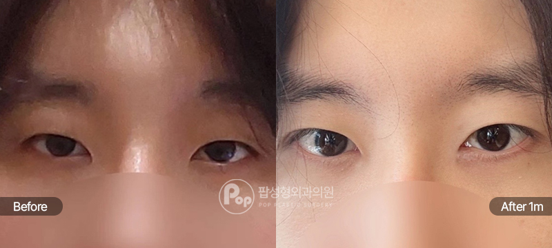 팝성형외과 12홀 자연유착 눈매교정 앞트임 윗트임 수술 전후 1개월차 눈매 비교 이미지