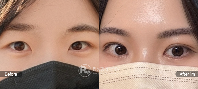 팝성형외과 12홀 자연유착 앞트임 윗트임 수술 전후 1개월차 눈매 비교 이미지