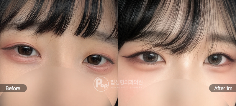 팝성형외과 12홀 자연유착 눈매교정 앞트임 윗트임 수술 전후 1개월차 눈매 비교 이미지