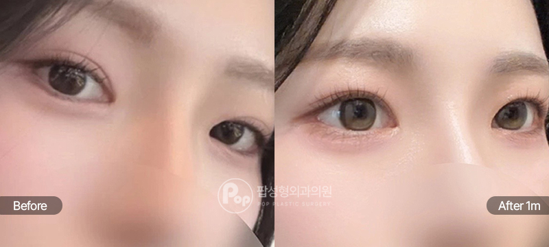 팝성형외과 뒤트임 밑트임 수술 전후 1개월차 눈매 비교 이미지