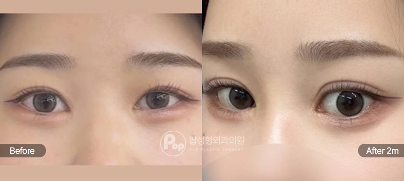 팝성형외과 12홀 자연유착 윗트임 앞트임 밑트임 뒤트임 눈재수술 전후 2개월차 눈매 비교 이미지