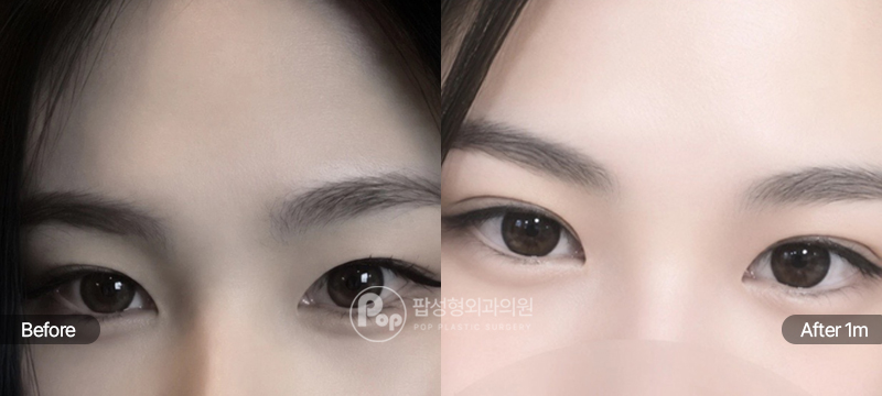 팝성형외과 12홀 자연유착 윗트임 눈재수술 전후 1개월차 눈매 비교 이미지