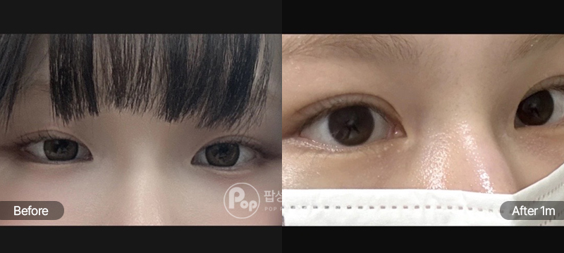 팝성형외과 12홀 자연유착 윗트임 눈재수술 전후 1개월차 눈매 비교 이미지