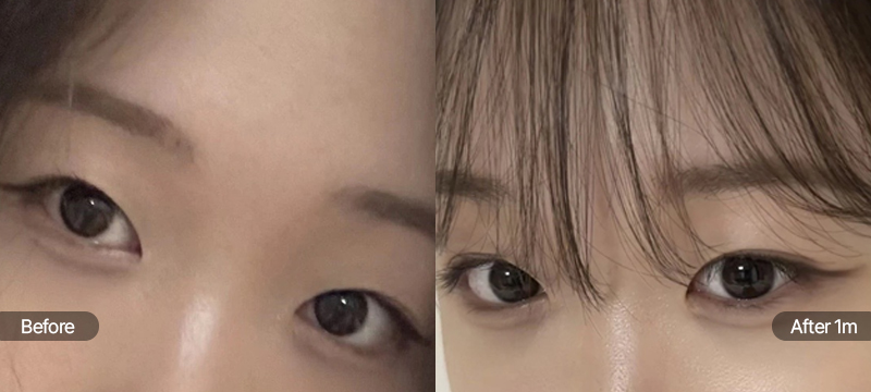 팝성형외과 12홀 자연유착 전후 1개월차 눈매 비교 이미지