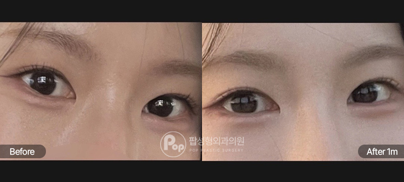 팝성형외과 뒤트임 밑트임 전후 1개월차 눈매 비교 이미지