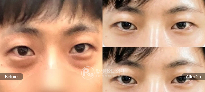 팝성형외과 눈밑지방재배치 전후 2개월차 비교 이미지