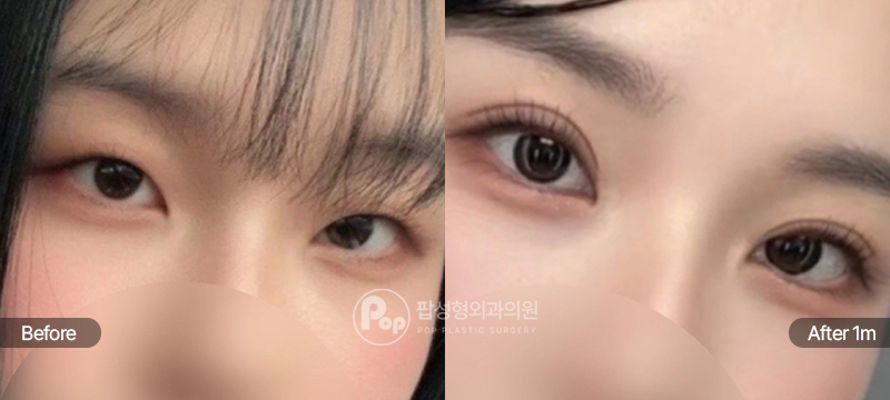 팝성형외과 12홀 자연유착 눈매교정 윗트임 전후 1개월차 눈매 비교 이미지