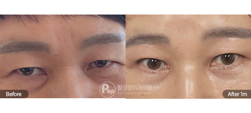 팝성형외과 눈썹하거상 하안검 전후 1개월차 중년 눈매 비교 이미지
