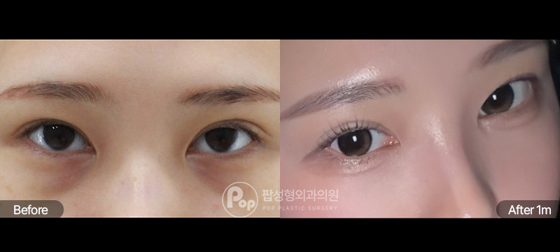 팝성형외과 눈밑지방재배치 전후 1개월차 비교 이미지