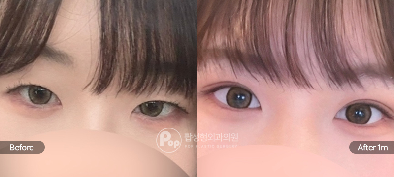 팝성형외과 12홀 자연유착 윗트임 전후 1개월차 눈매 비교 이미지