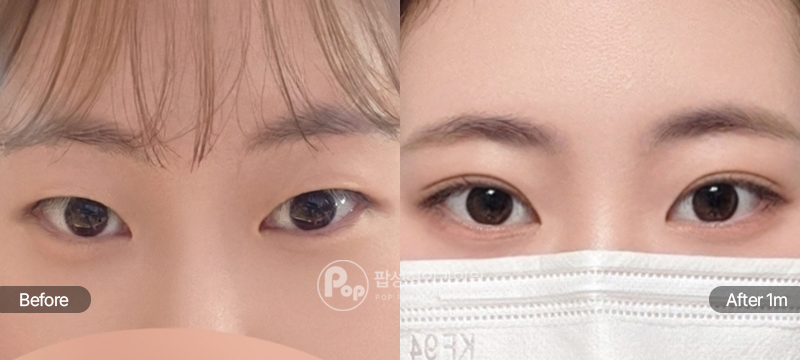 팝성형외과 12홀 자연유착 전후 1개월차 눈매 비교 이미지