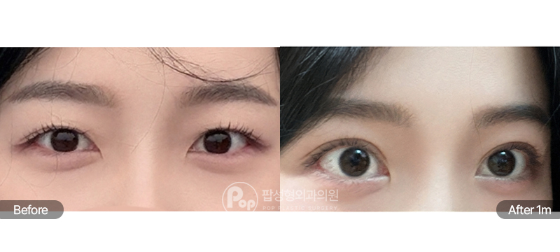 팝성형외과 12홀 자연유착, 눈매교정, 윗트임 전후 1개월차 비교 이미지