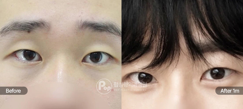 팝성형외과 12홀 자연유착, 눈매교정 남자눈성형 전후 1개월차 비교 이미지