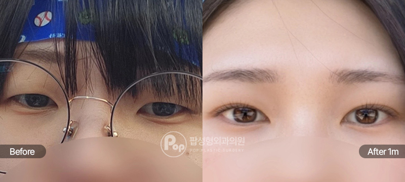 팝성형외과 12홀 자연유착, 눈매교정, 윗트임, 앞트임, 눈위지방제거 전후 1개월차 비교 이미지