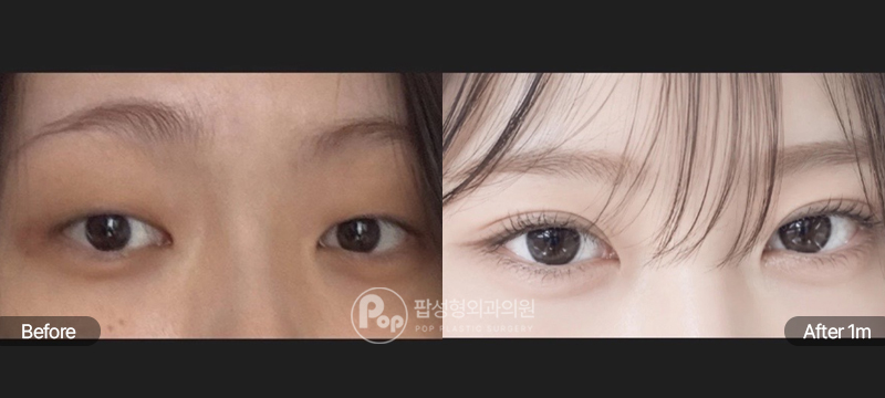 팝성형외과 12홀 자연유착, 눈매교정, 윗트임 전후 1개월차 비교 이미지