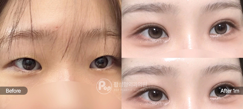 팝성형외과 12홀 자연유착, 눈매교정, 윗트임, 앞트임 전후 1개월차 비교 이미지