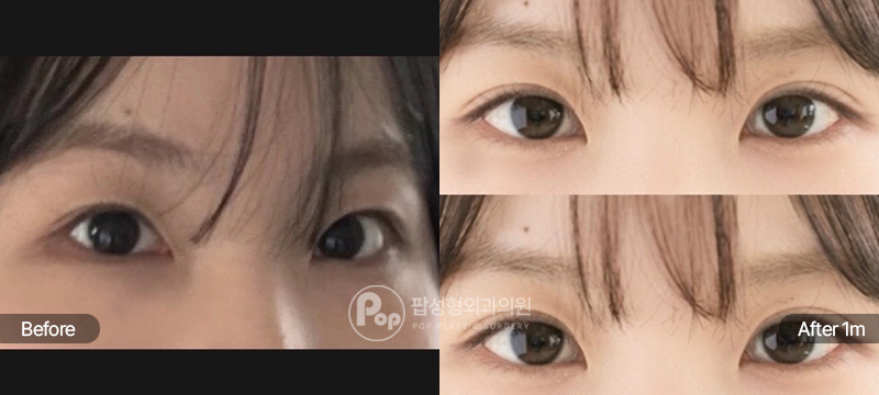 팝성형외과 12홀 자연유착, 눈매교정, 윗트임, 뒤트임, 밑트임 전후 1개월차 비교 이미지