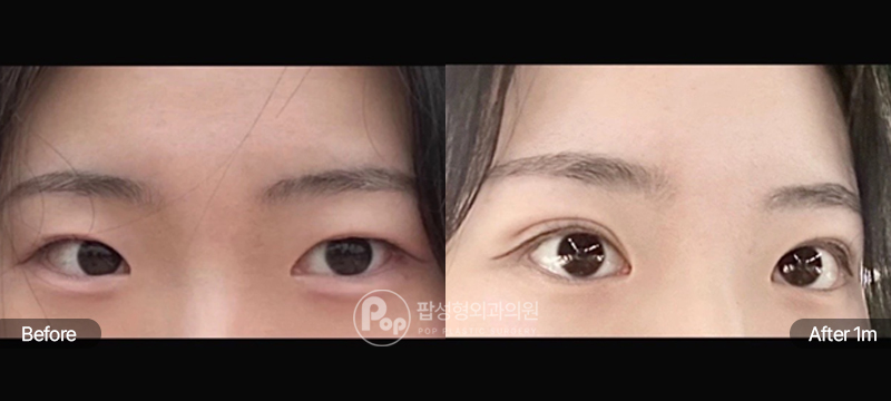 팝성형외과 12홀 자연유착 눈재수술 전후 1개월차 비교 이미지