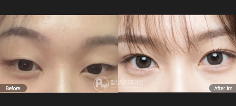 팝성형외과 12홀 자연유착, 눈매교정, 윗트임 전후 비교 이미지