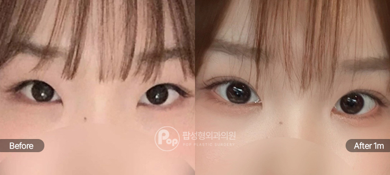 팝성형외과 12홀 자연유착, 눈매교정, 앞트임, 윗트임 전후 비교 이미지