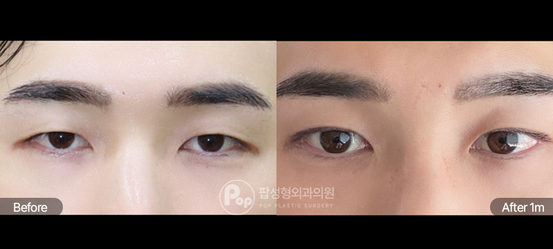 팝성형외과 남자 12홀 자연유착 눈매교정 수술 전후 1개월차 눈매 비교 이미지