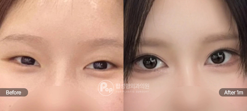 팝성형외과 12홀 자연유착 앞트임 윗트임 뒤트임 밑트임 수술 전후 1개월차 눈매 비교 이미지