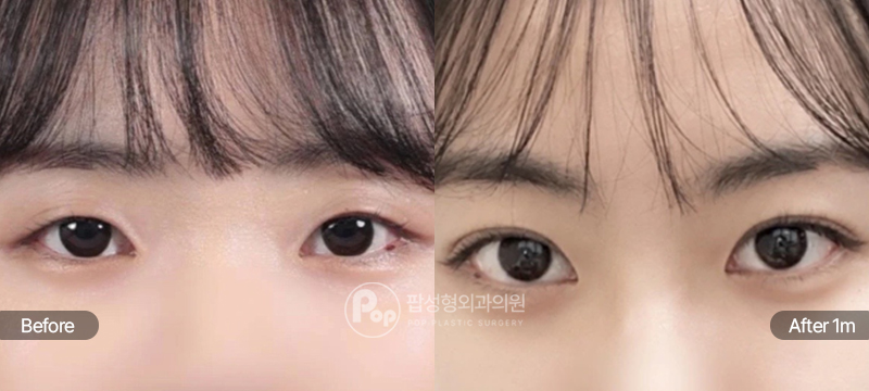 팝성형외과 12홀 자연유착 눈매교정 앞트임 윗트임 수술 전후 1개월차 눈매 비교 이미지