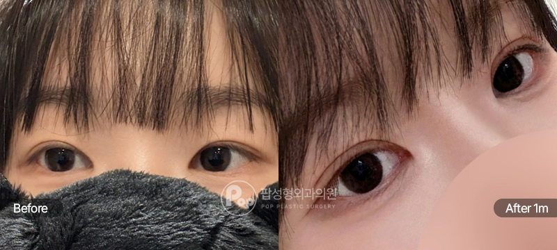 팝성형외과 12홀 자연유착 눈매교정 앞트임 윗트임 수술 전후 1개월차 눈매 비교 이미지