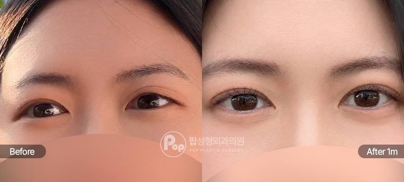 팝성형외과 12홀 자연유착 눈재수술 전후 1개월차 눈매 비교
