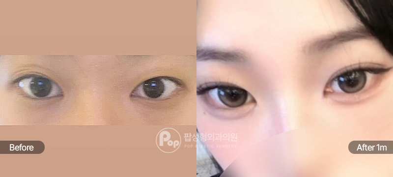 팝성형외과 12홀 자연유착 윗트임 수술 전후 1개월차 눈매 비교