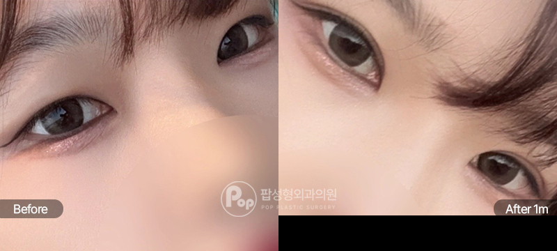 팝성형외과 12홀 자연유착 눈매교정 윗트임 수술 전후 1개월차 눈매 비교