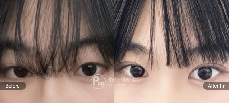 팝성형외과 12홀 자연유착 눈매교정 윗트임 앞트임 수술 전후 1개월차 눈매 비교