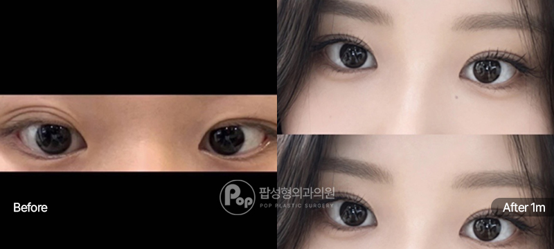 팝성형외과 12홀 자연유착 윗트임 앞트임 눈재수술 전후 1개월차 눈매 비교