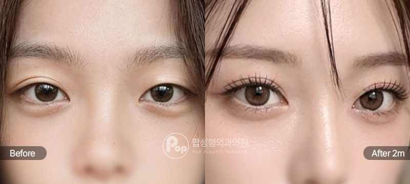 12홀 자연유착 윗트임 앞트임 눈재수술 전후 2개월차 비교