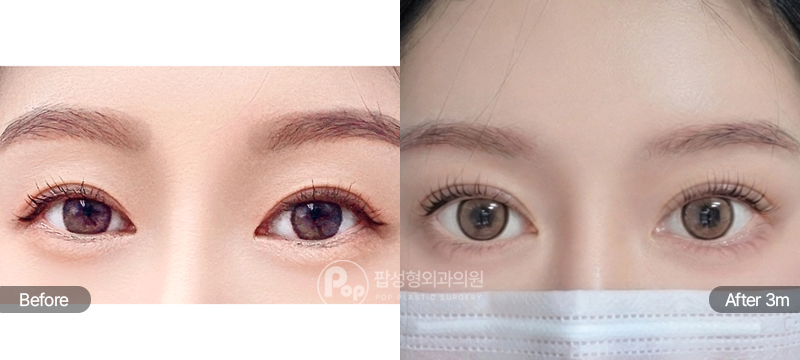 12홀 자연유착 눈매교정 윗트임 눈재수술 3개월차 전후 비교