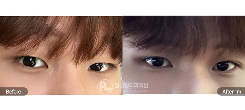 12홀 자연유착 눈매교정 남자눈성형 1개월차 전후 비교