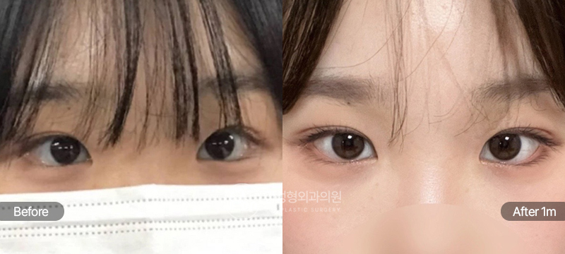 12홀 자연유착 윗트임 앞트임 1개월차 전후 비교
