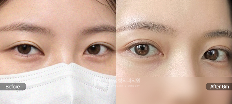 12홀 자연유착 눈매교정 윗트임 눈재수술 6개월차 전후 비교
