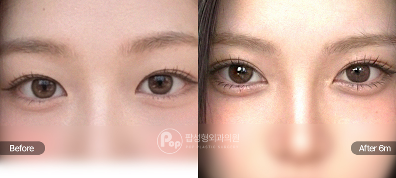 12홀 자연유착 세미아웃라인 쌍꺼풀 수술 6개월차 전후 비교